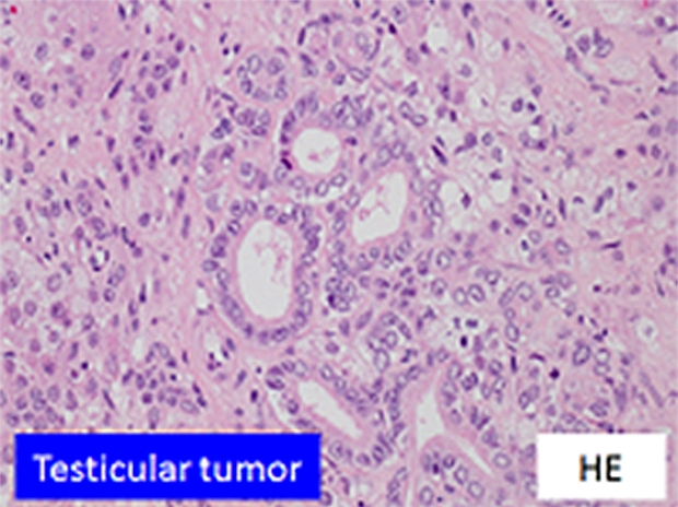 Testicular tumor イメージ01